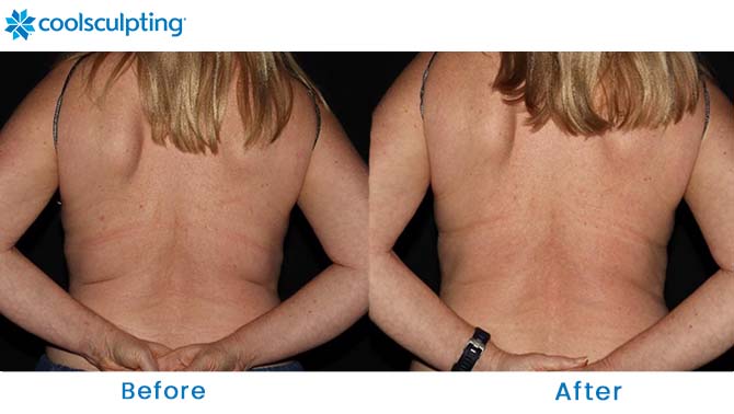 coolsculpting bra fat dr. phillips