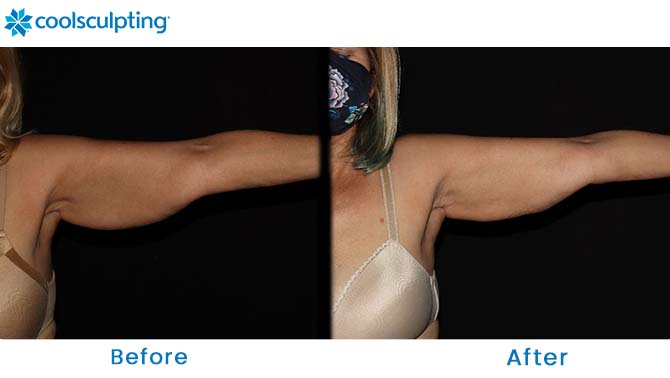 coolsculpting for arms before and after Dr. Phillips - Orlando