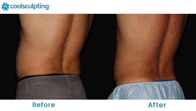 coolsculpting before and after love handles orlando