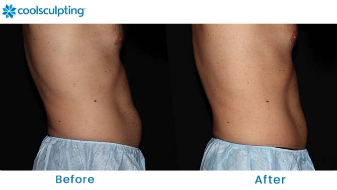 CoolSculpting before and after abs winter park orlando