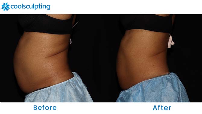 CoolSculpting before and after photos abdomen in Orlando