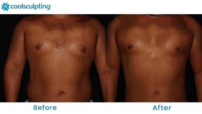coolsculpting before and after love handles dr. phillips - orlando