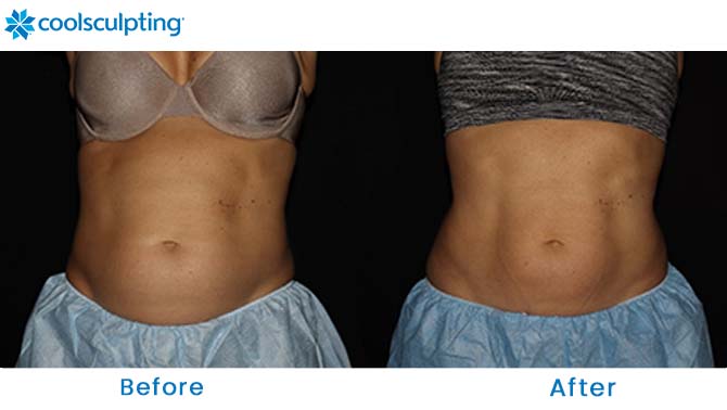 CoolSculpting Before and After Photos Abdomen Orlando