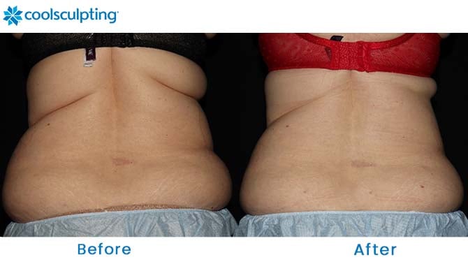 coolsculpting bra fat dr. phillips orlando