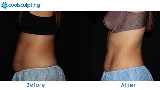 CoolSculpting Before and After Photos Abdomen Near Me