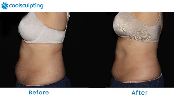 CoolSculpting flanks winter park  