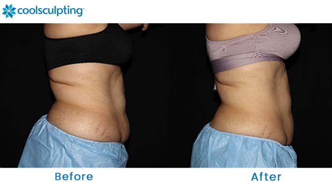 CoolSculpting flanks orlando  