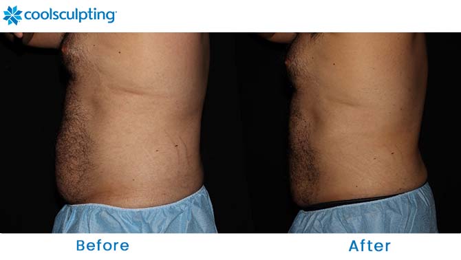 coolsculpting before and after love handles orlando florida