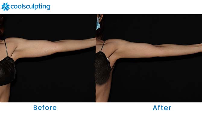 coolsculpting for arms before and after Orlando