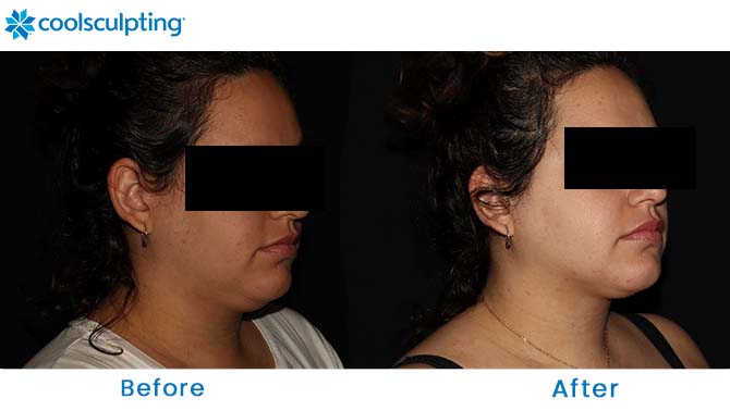 CoolSculpting Chin Before and After Dr. Phillips Orlando