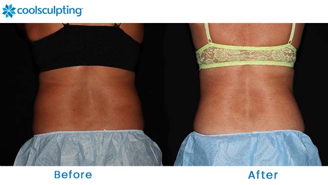 CoolSculpting flanks Winter Park FL