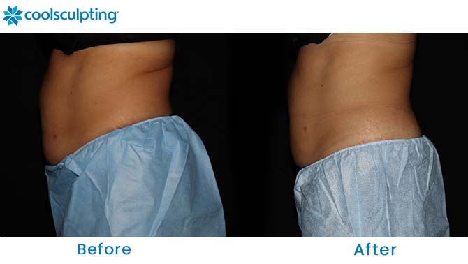 CoolSculpting flanks Dr. Phillips fl