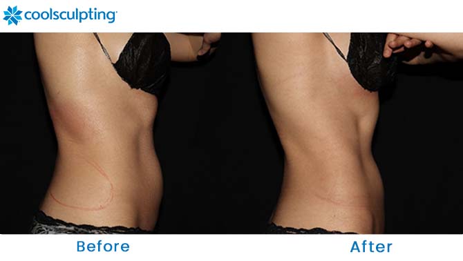 CoolSculpting flanks before and after Orlando FL