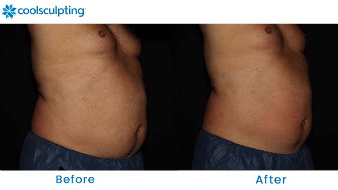 CoolSculpting male stomach near me
