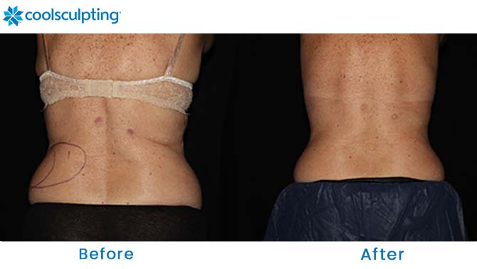 CoolSculpting flanks dr. phillips orlando