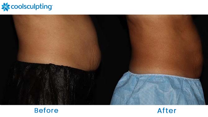 CoolSculpting before and after abs orlando