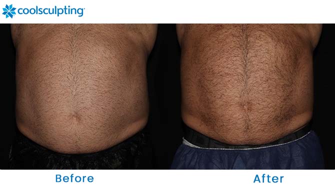 CoolSculpting male stomach orlando 