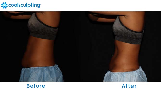 coolsculpting upper abdomen before and after 