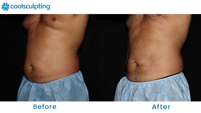 CoolSculpting male stomach winter park fl