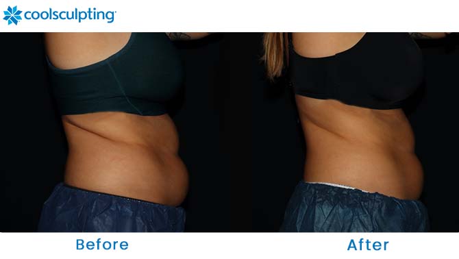 CoolSculpting flanks before and after near me