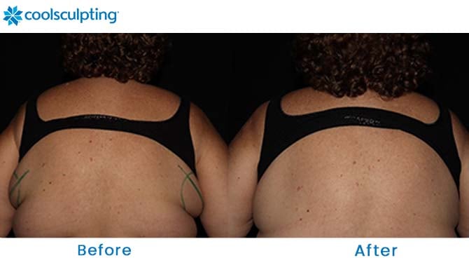 Coolsculpting Before and After Pictures - Female Bra Fat/Back