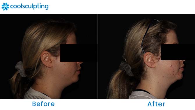CoolSculpting Chin Before and After Dr. Phillips FL