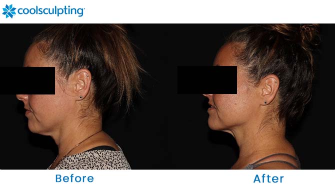 CoolSculpting Chin Before and After Near Me
