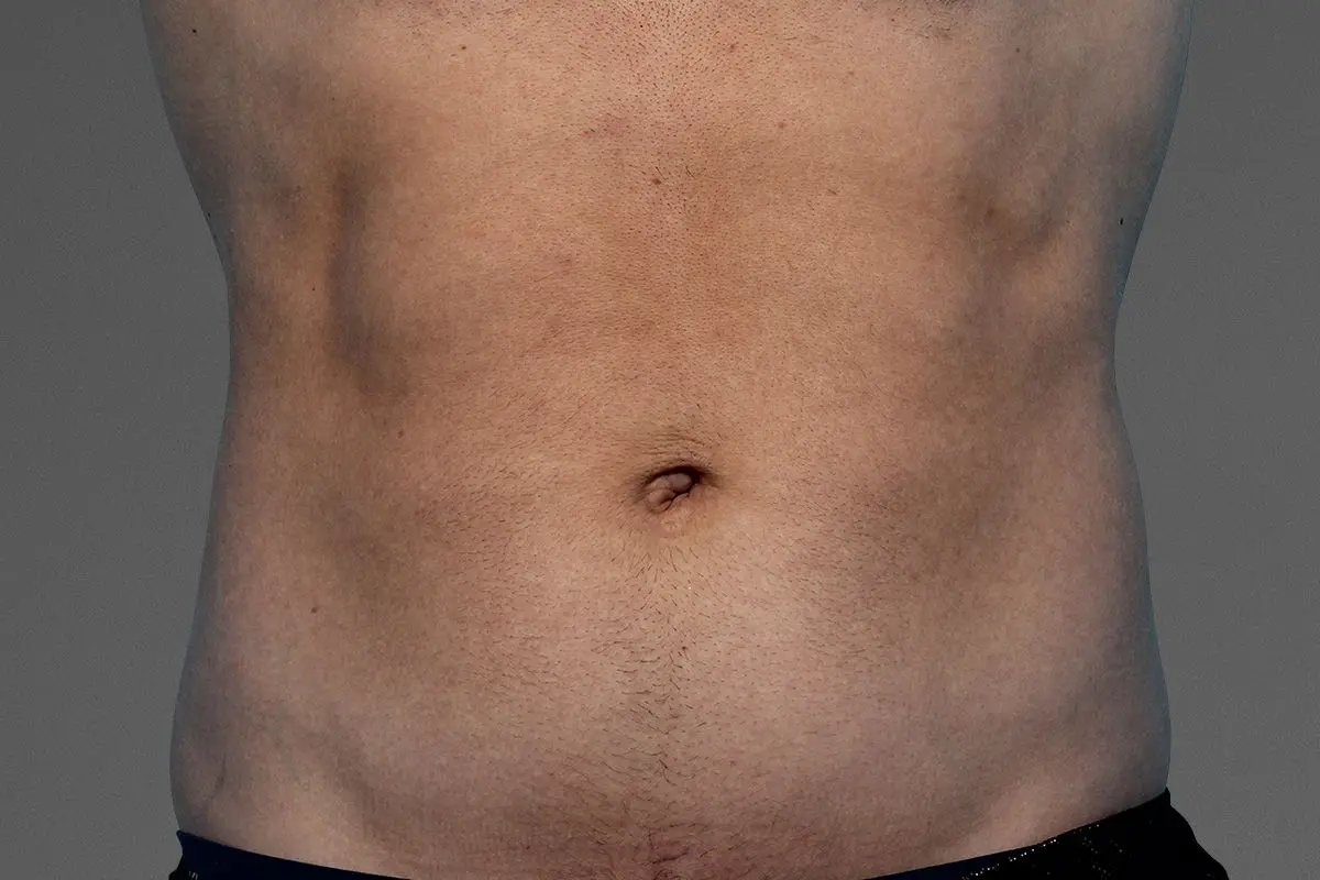 Muscle toning after