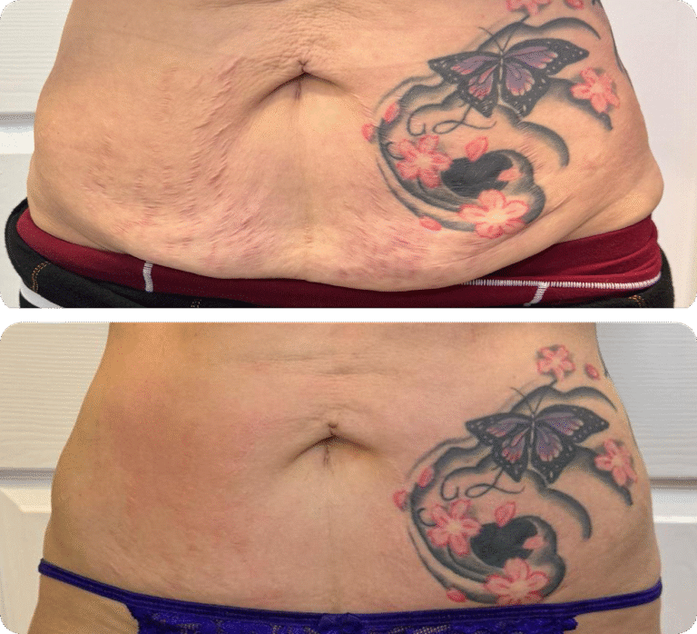 Bodenvy real client before and after 5-Step Renewal skin tightening — tightened stomach skin after weight loss program