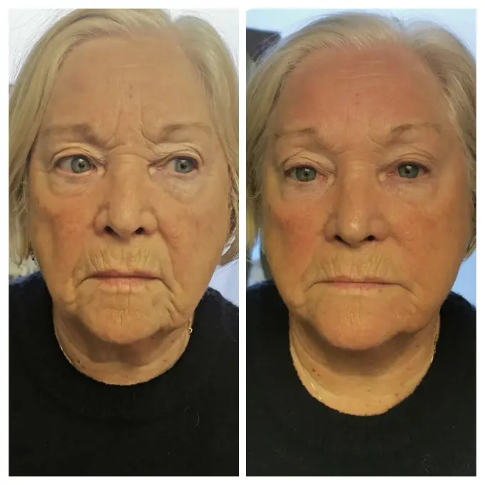 Bodenvy client before and after skin tightening: Refreshed and Lifted