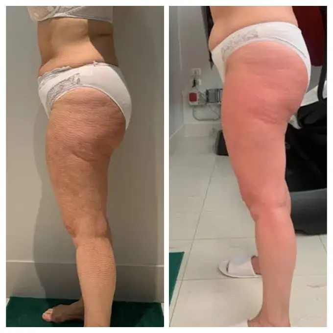 t-shape-2-ba-cellulite-treatment-1