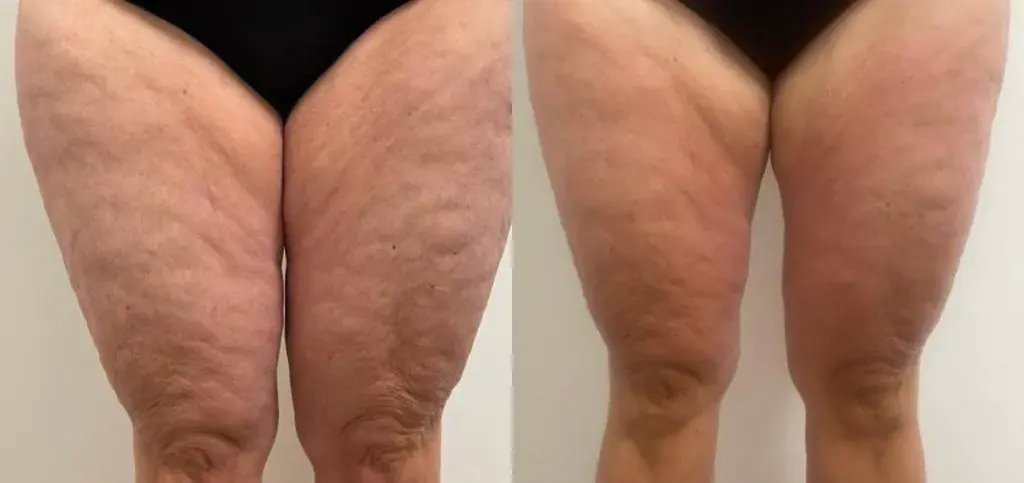 Bodenvy real client before and after 5-Step Renewal skin tightening — firmer thigh skin after weight loss program